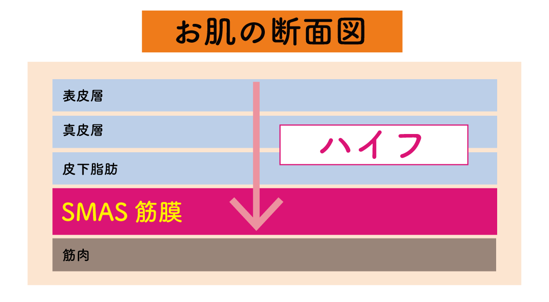 ハイフの主な効果<br />