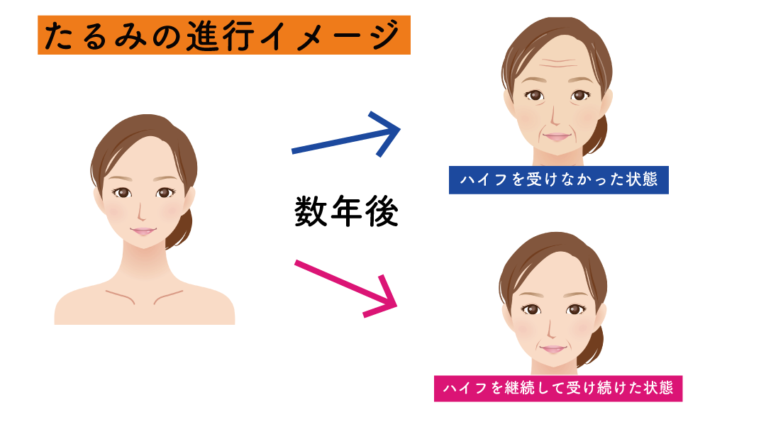 ハイフの効果に対する勘違い