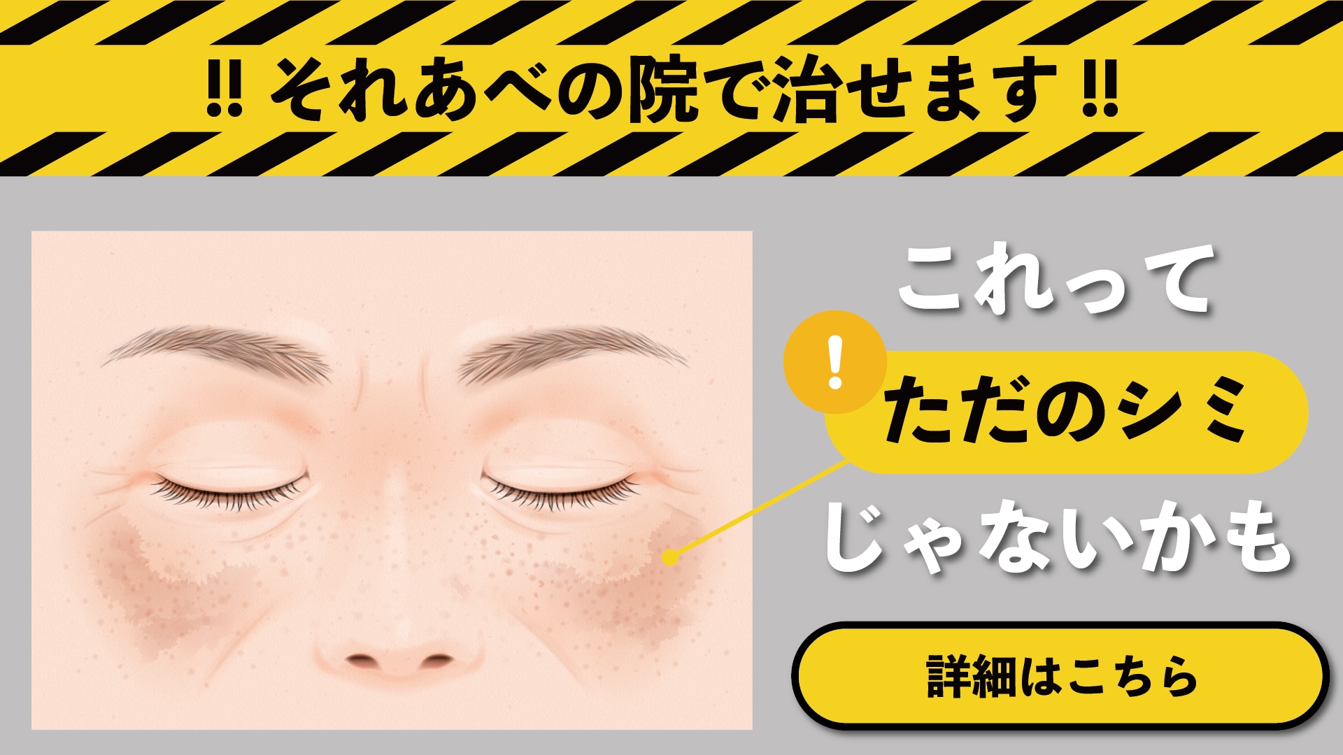 肝 斑 シミ 違い