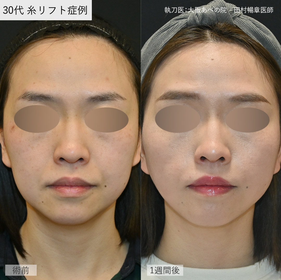 糸リフトの最適な本数って?理想のフェイスラインを叶える本数の目安 - 大阪あべの院