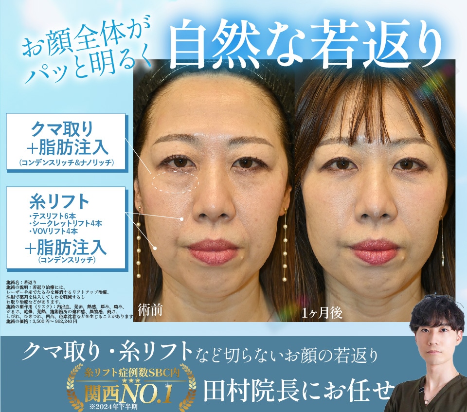クマ取り&糸リフト