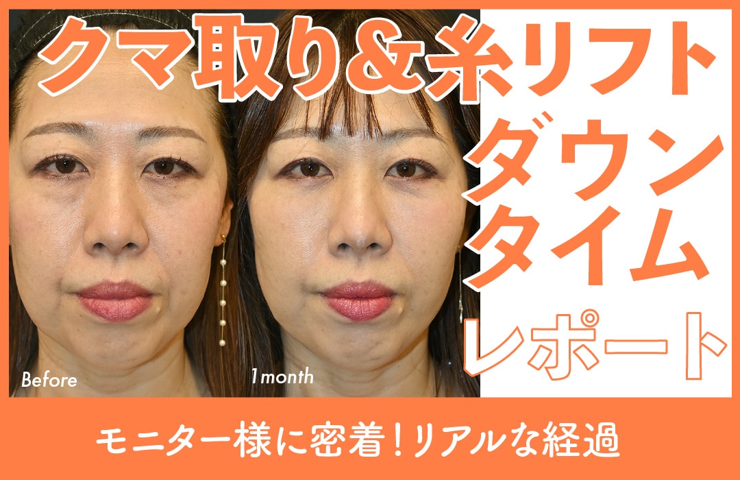 【切らない若返り】糸リフトと目の下のクマ取りで顔全体をトータルプロデュース