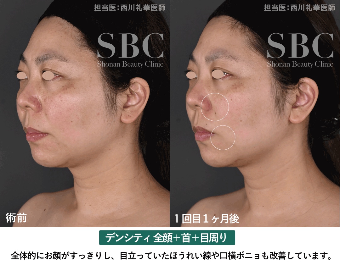 顔全体・首・目周りに照射