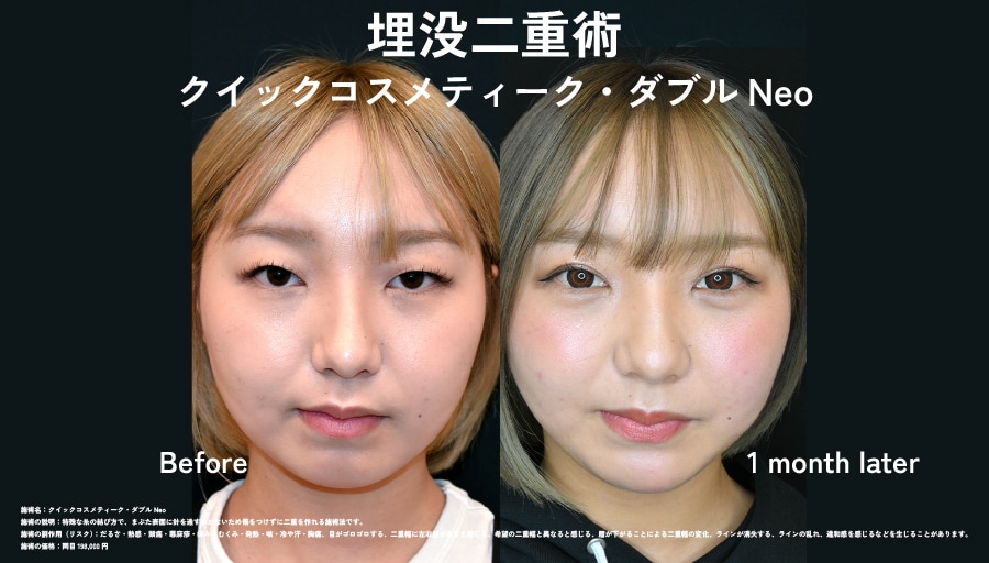 瞳に光が入り、第一印象が劇的に変わる。あべの院のオーダーメイド二重