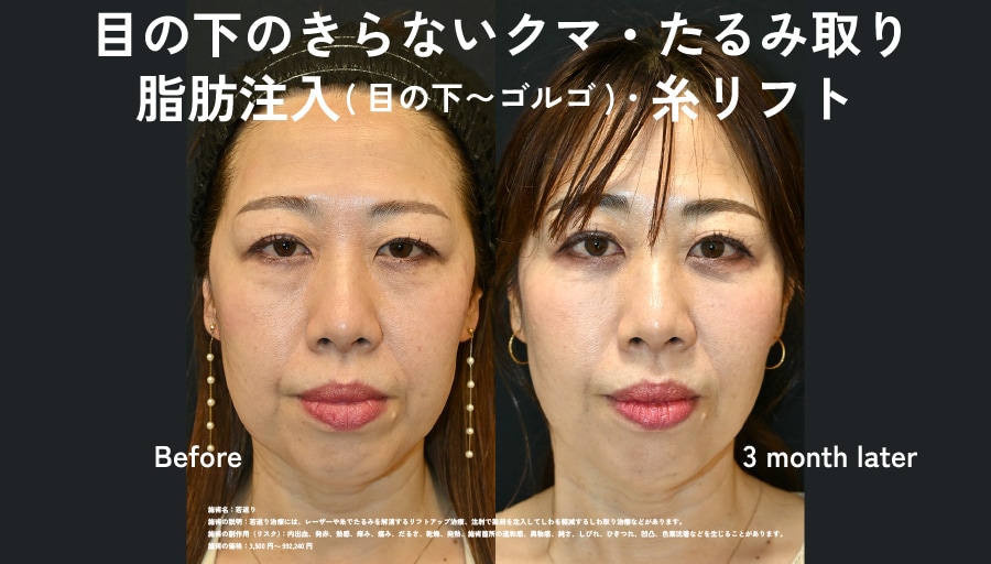 隠すメイクはもう終わり。コンシーラーいらずの明るい目元を15%OFFで