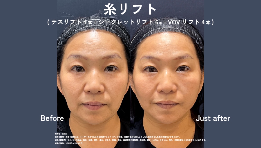 田村院長（テスリフト症例数SBC内関西4年連続No.1）が執刀。横顔まで隙のないシャープな輪郭へ