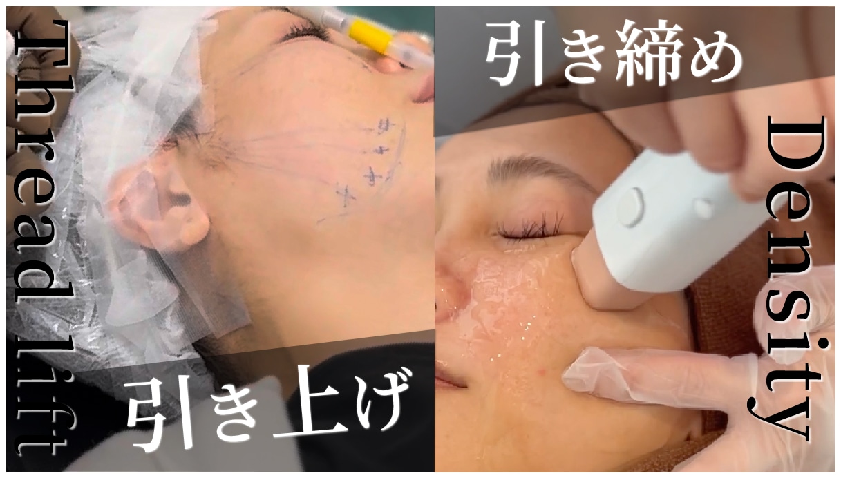 なぜ、30代からこの2つの治療を組み合わせるべきなのか？<br />
それは、単体治療では届かない「立体的リフトアップ」が可能になるからです。