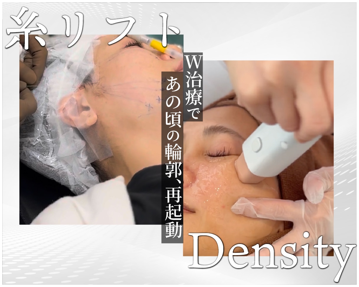糸リフト×デンシティの相乗効果でキュッと上がった輪郭を最速GET！SBC大阪あべの院で同日施術可能★