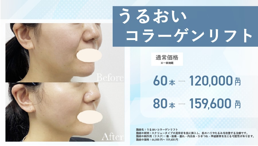【うるおいコラーゲンリフト】美容針で「内側からパンッ！」