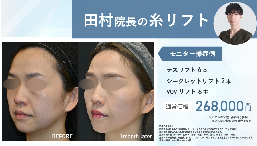 【糸リフト】物理的なリフトアップで「即・小顔」