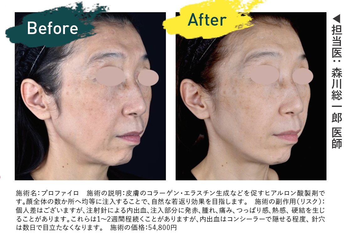 プロファイロ 症例