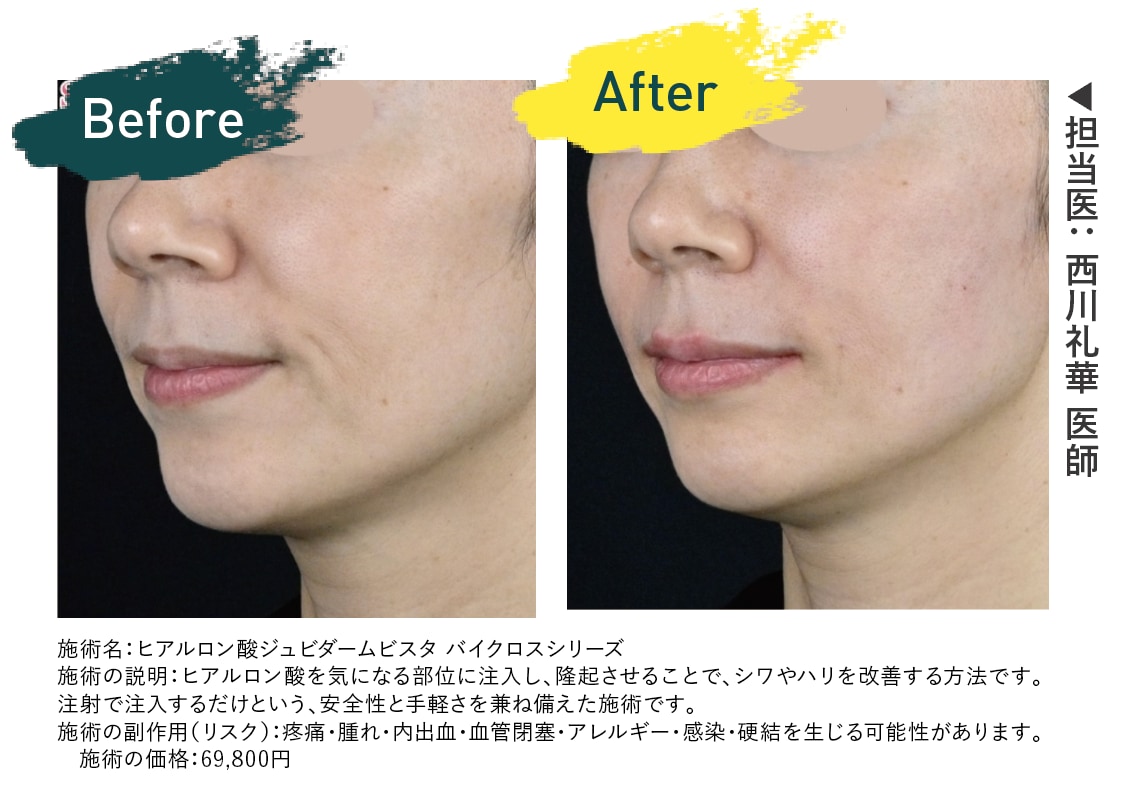 ヒアルロン酸 症例