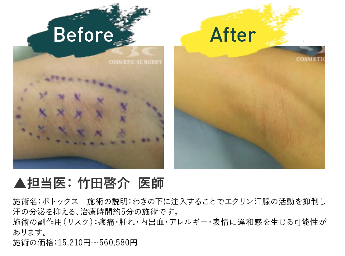 ワキ汗止め 症例