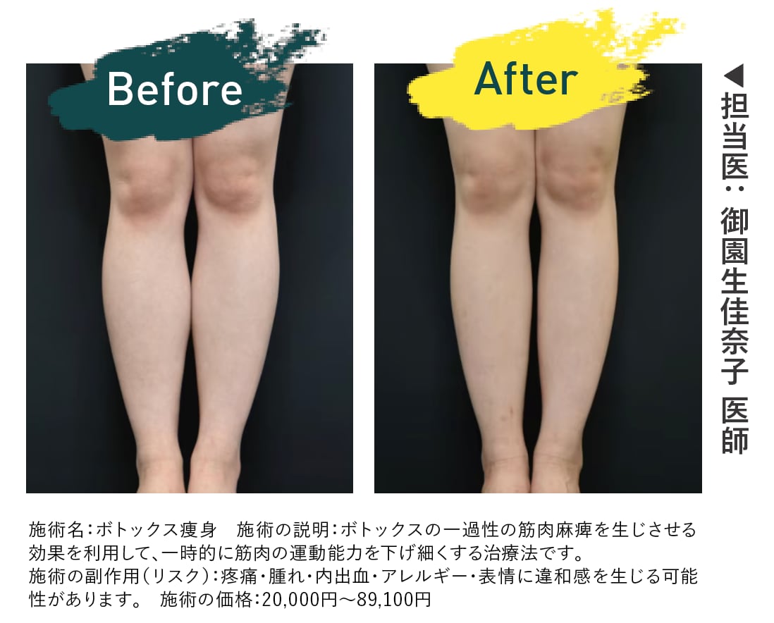 ふくらはぎ 症例