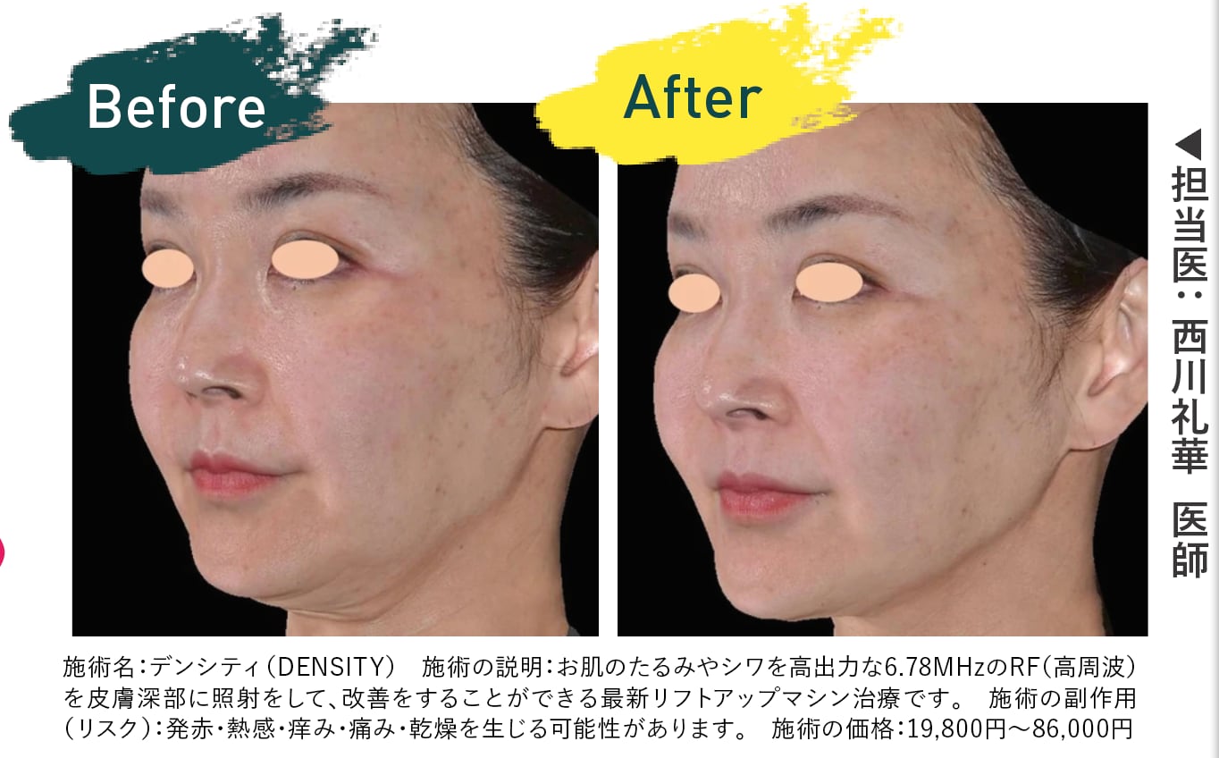 デンシティ 症例