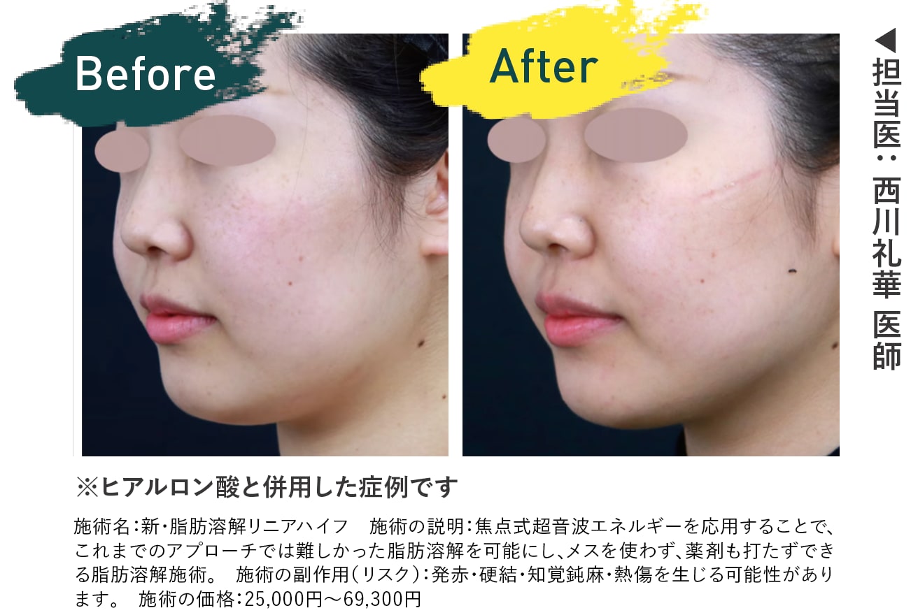 リニアハイフ 症例