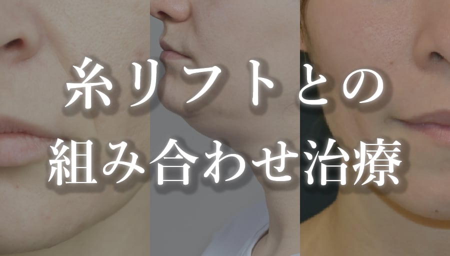 ほうれい線が気になる方