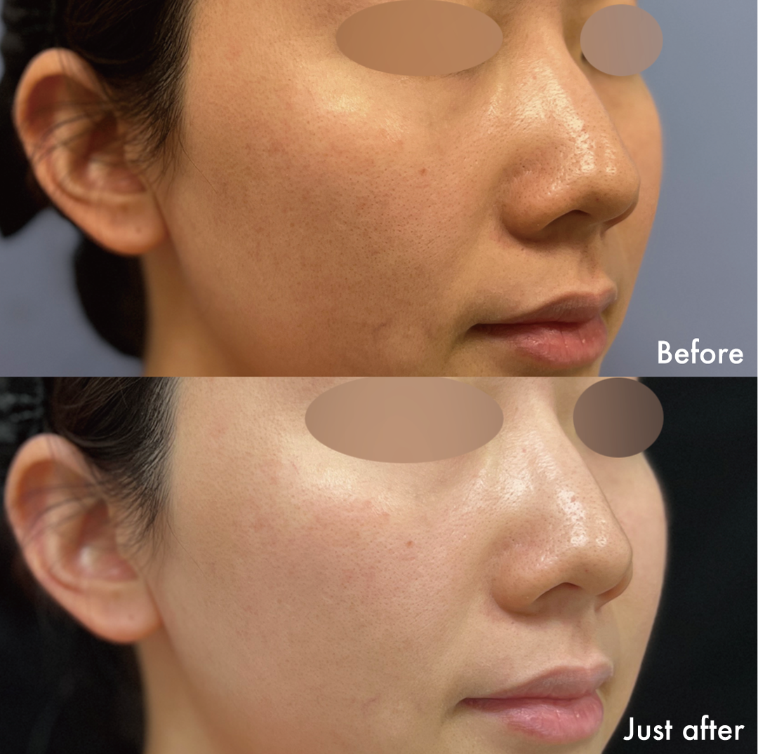 グロウピール症例3