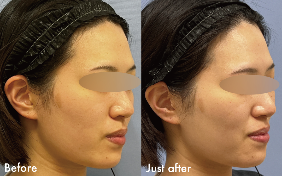 グロウピール症例1