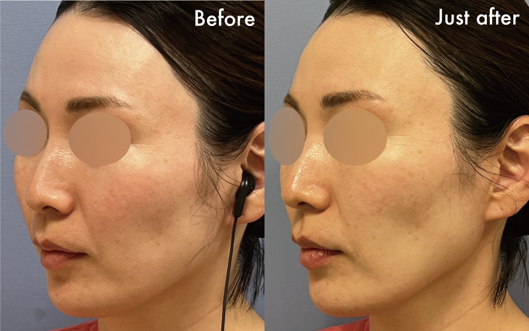 グロウピール症例2