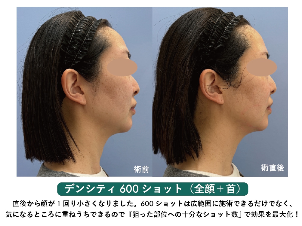 <div id="density-600" >デンシティのショット数はどれを選べばいい？</div>
