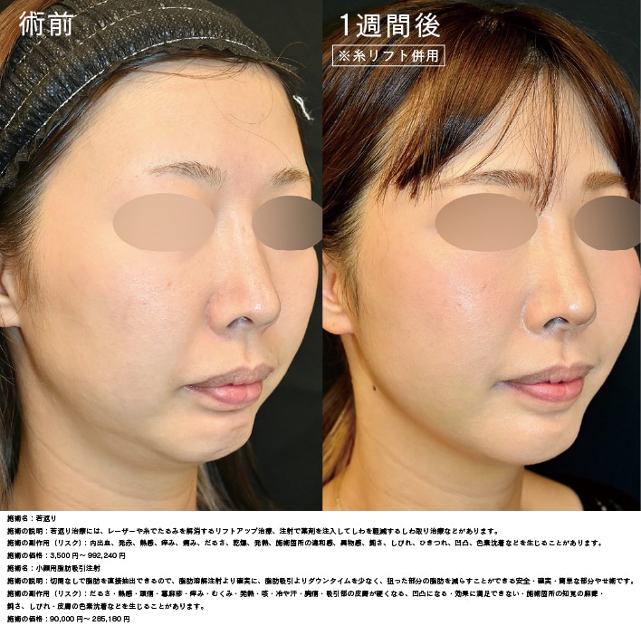 脂肪吸引注射 症例写真