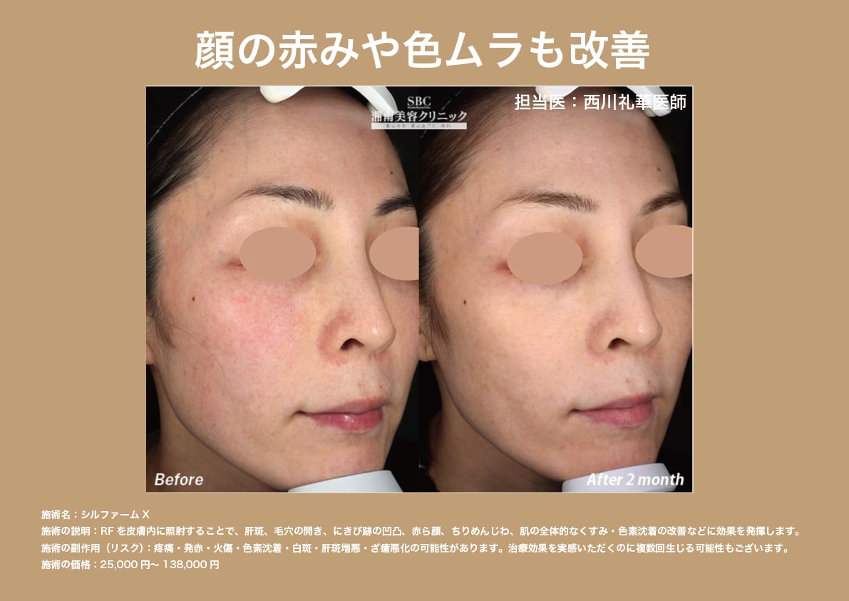 顔の赤みや色ムラにも効果的！