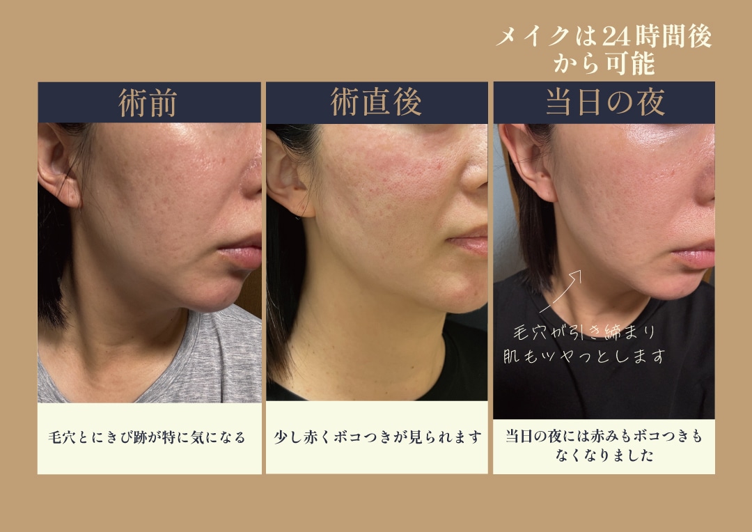 ダウンタイムはどんな感じ？
