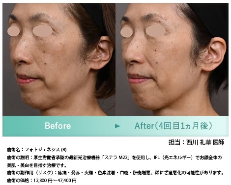 フォトジェネシス症例