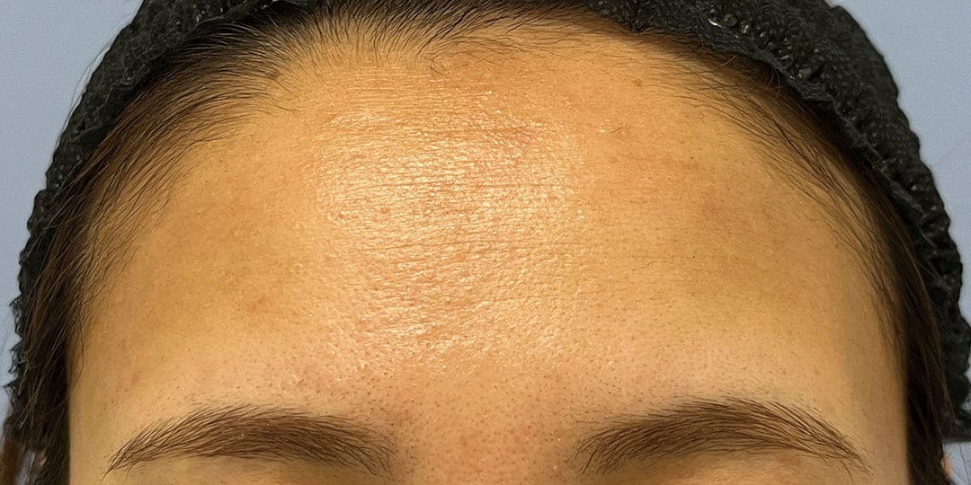 女優注射 Before
