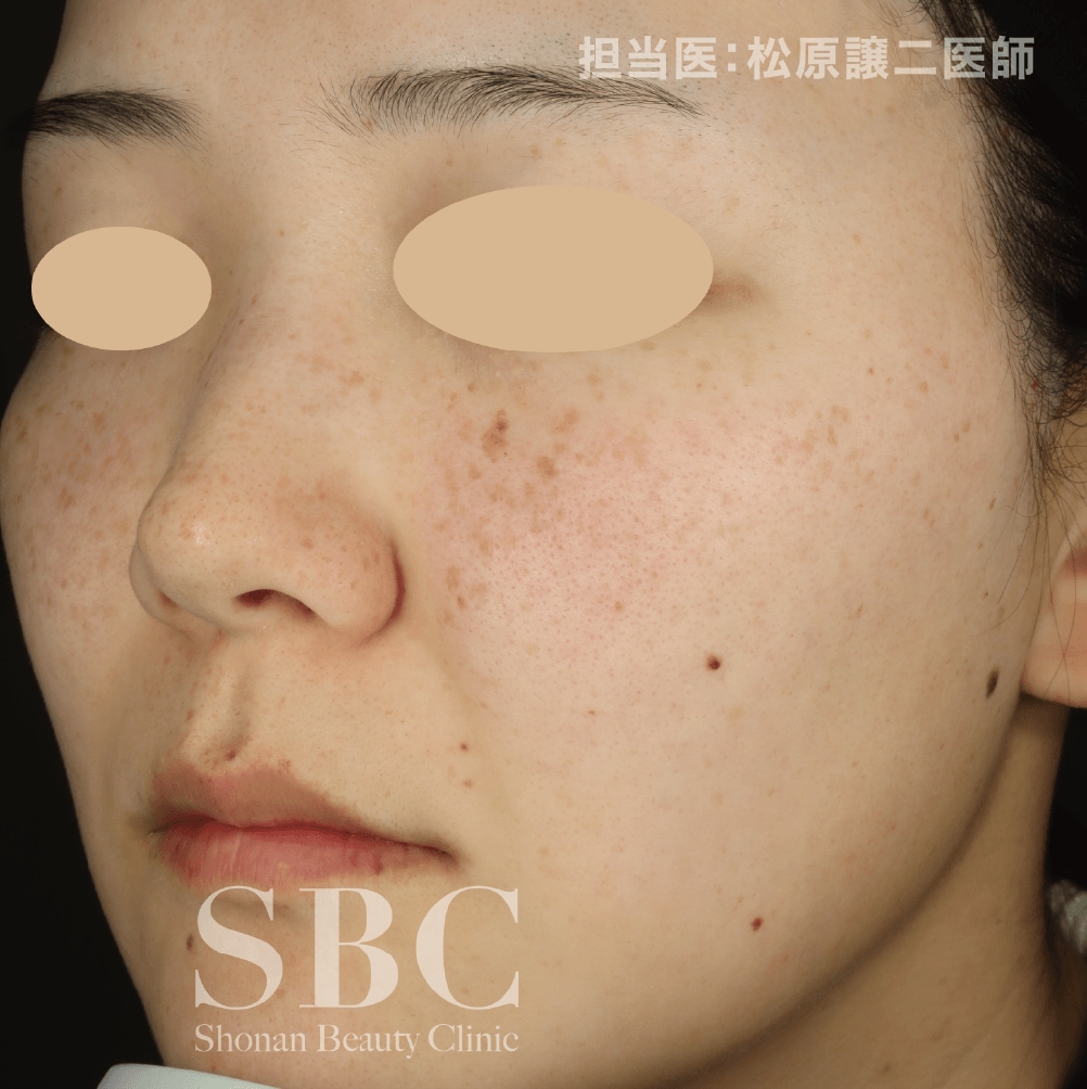 シミ取り Before
