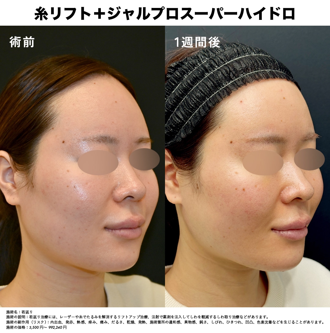糸リフト×ジャルプロ 究極の若返りセットイメージ