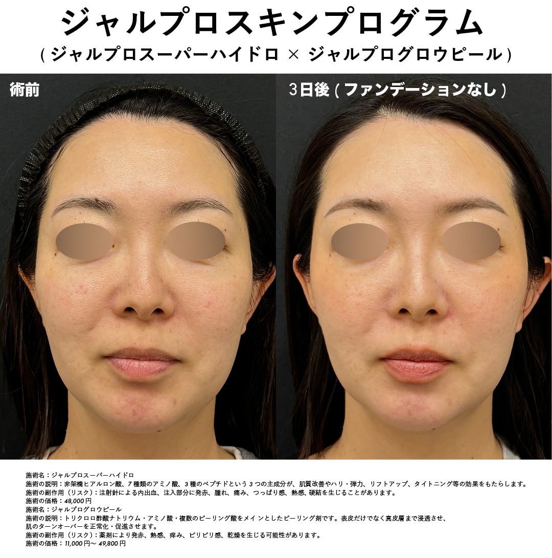 ジャルプロスキンプログラム 症例写真