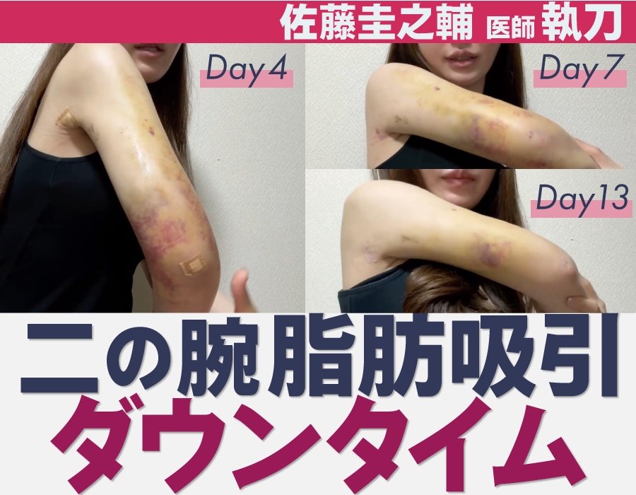脂肪吸引初心者向け／ダウンタイム不安な人必見！【脂肪吸引の名医 