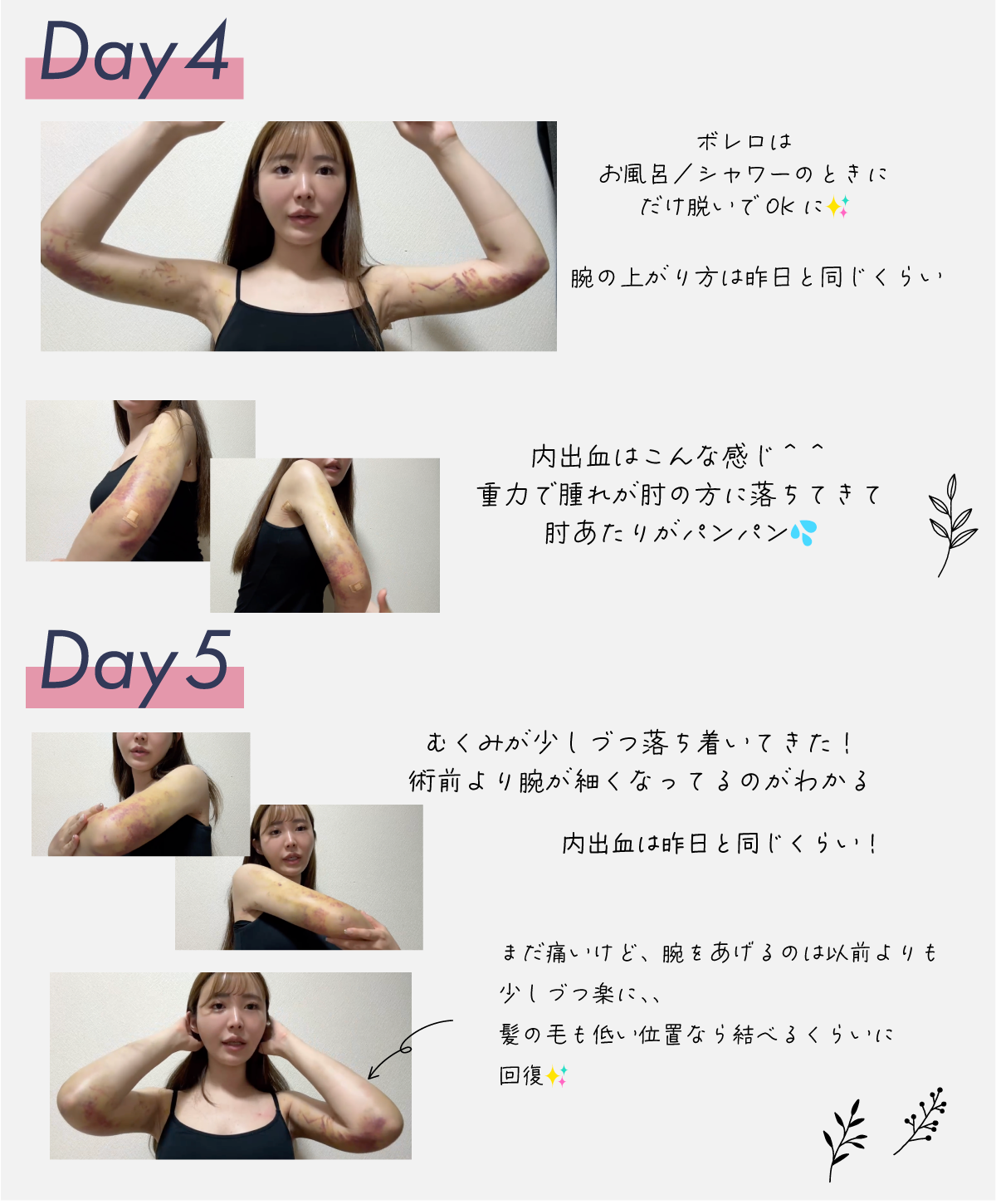 アミュレット sssサイズ 湘南美容外科 二の腕 脂肪吸引 ボレロ 着圧 圧迫 アミュレット 二の腕 脂肪 湘南美容クリニック　二の腕　脂肪吸引　着圧ボレロ　着圧インナー