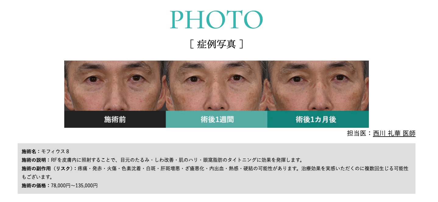術前〜1週間後〜1ヶ月後