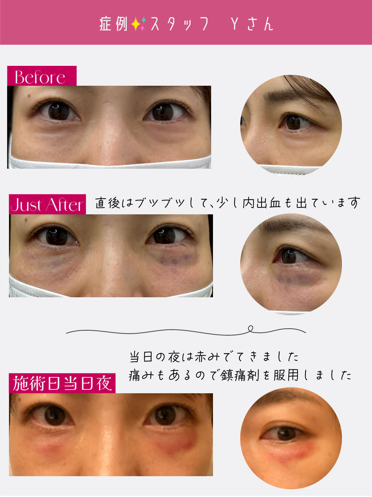 《密着》モフィウス８【目元】ダウンタイムレポート❶