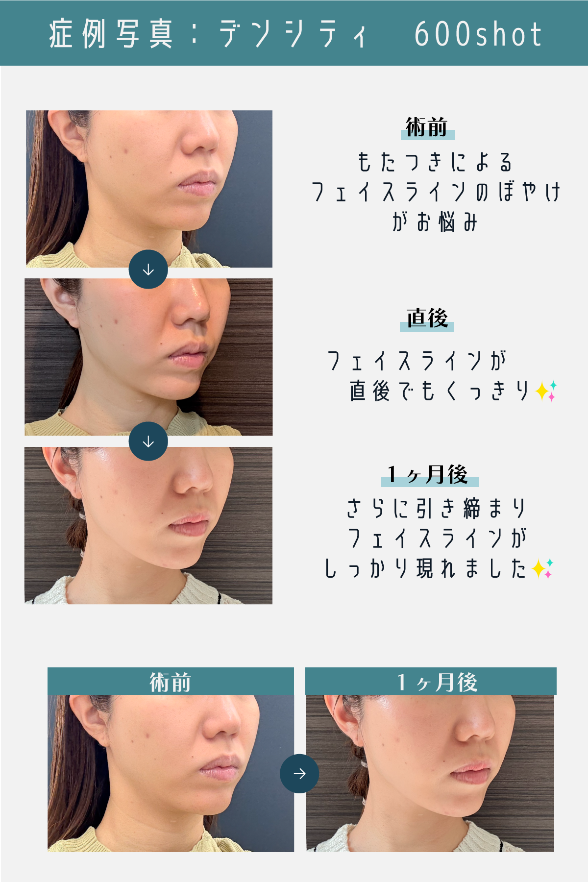 Aさん（32歳／ほうれい線・フェイスラインのもたつき・ぼやけ）<br />
