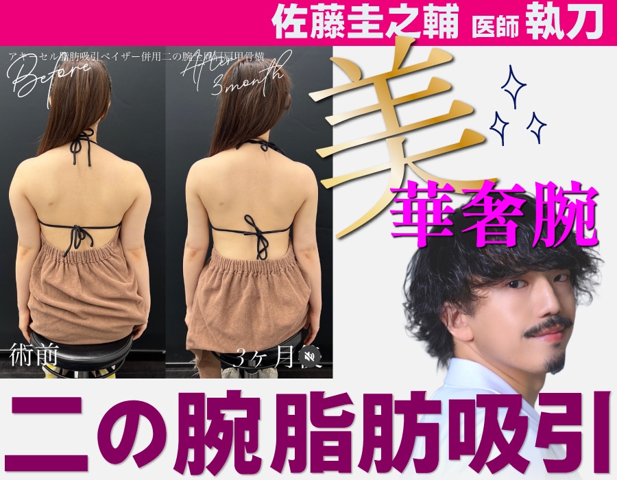 【ダイエットで落ちない二の腕が変わる】ぷよぷよ二の腕とお別れする👋東京のベイザー×アキーセル脂肪吸引で叶える、写真映えするほっそり“美”華奢腕【赤羽院院長　佐藤圭之輔医師】