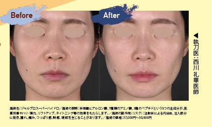 Before /After