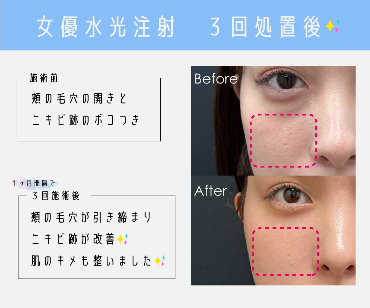 効果抜群の《肌育》リジュランヒーラー×スキンボトックス×水光注射　はやっぱりすごい！！