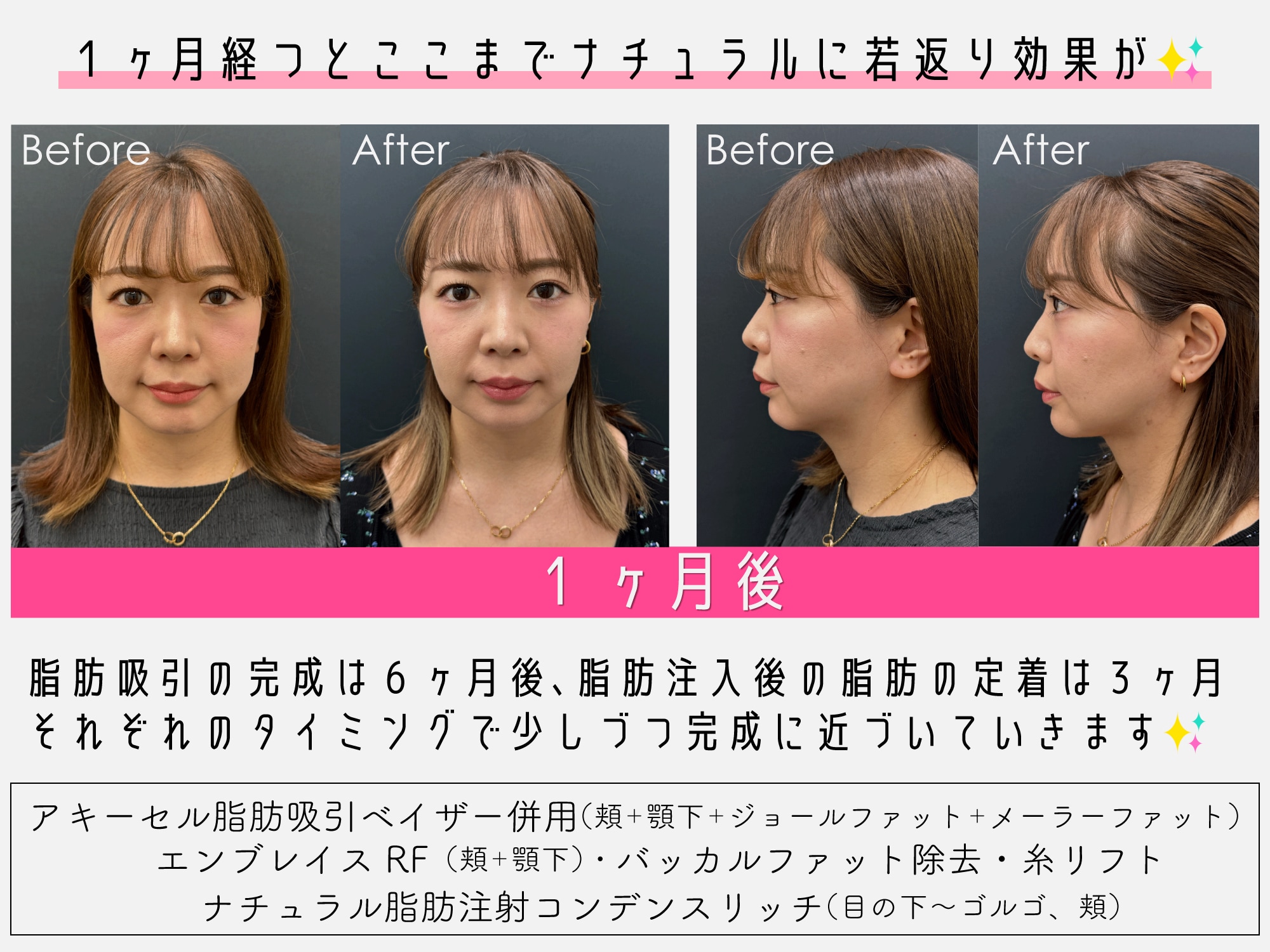 【症例写真】気になる１ヶ月後…✨