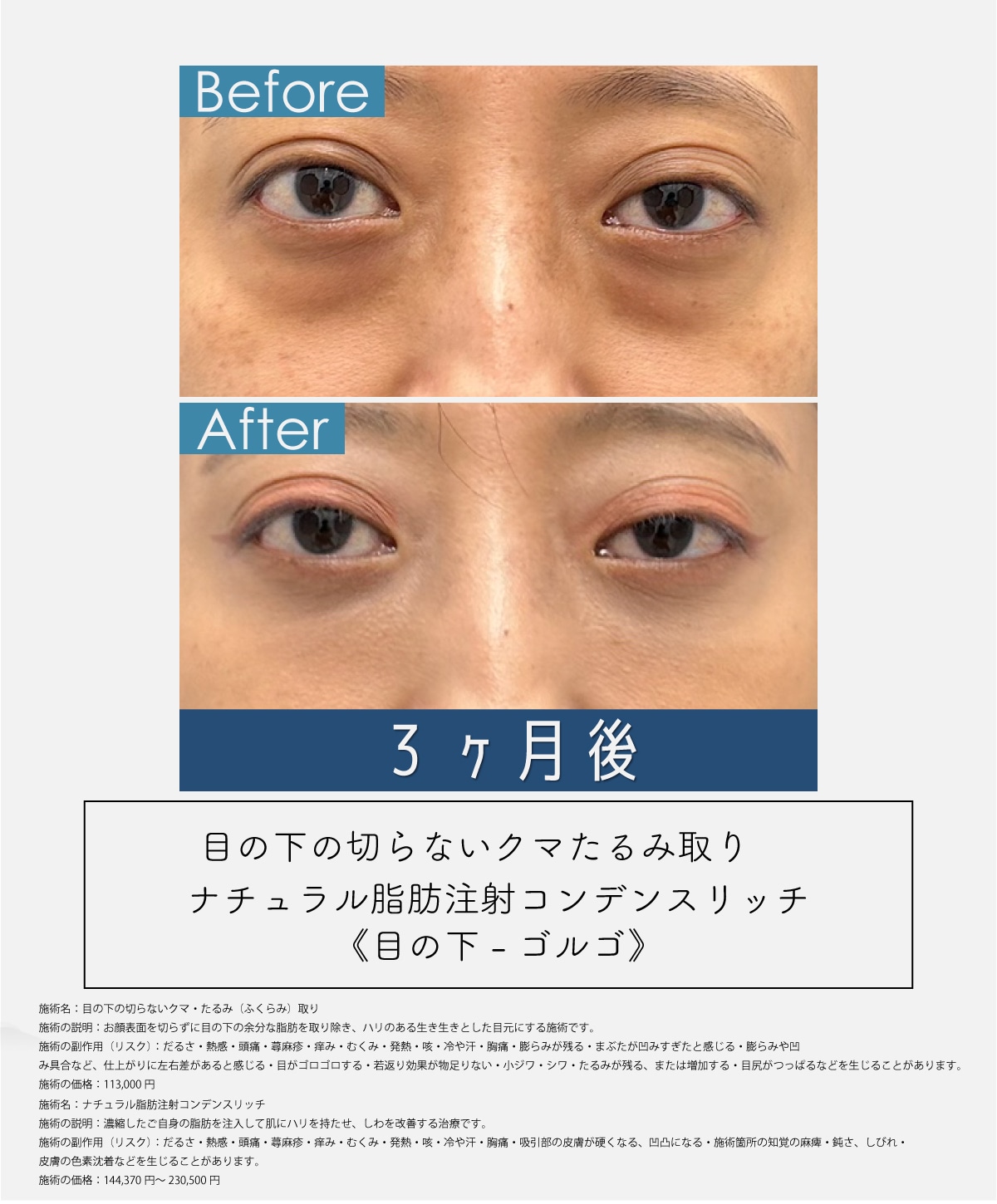 クマ取りも指名殺到【目の下のクマたるみ取り＋ナチュラル脂肪注射】