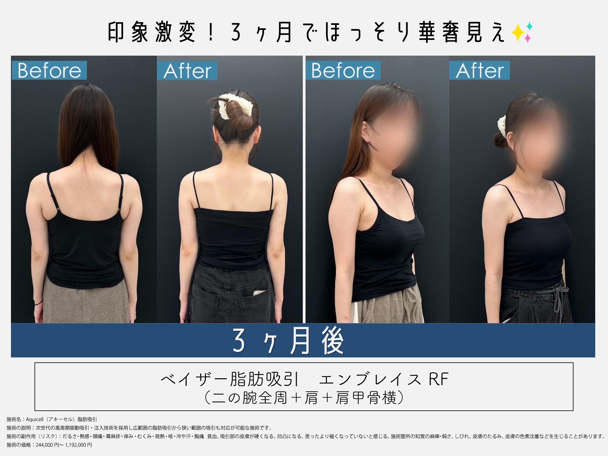 得意施術【脂肪吸引】ほっそり二の腕✨