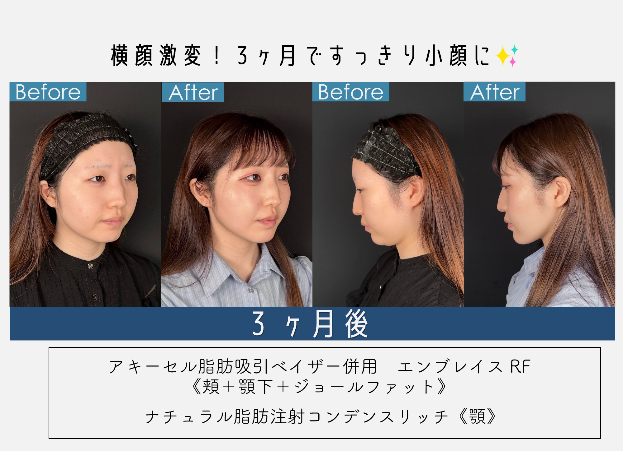 得意施術【脂肪吸引】すっきり小顔へ✨