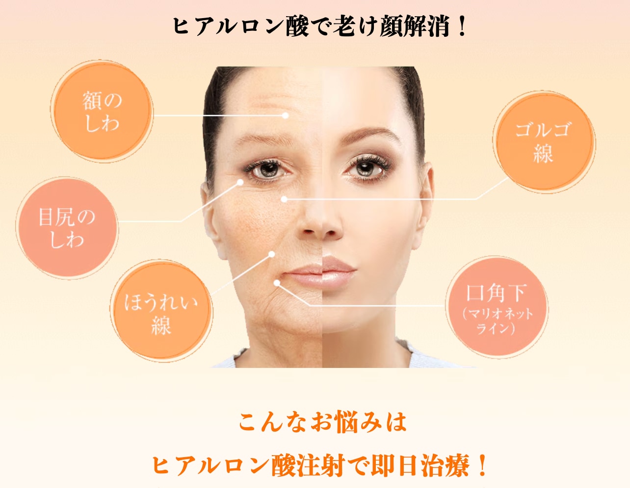 No.3🥉 顎・鼻筋／ほうれい線／涙袋＆唇　で若々しさ＆可愛さぐーんとUP⬆︎【ヒアルロン酸】
