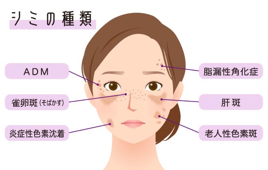 シミ治療を失敗しないために、、、