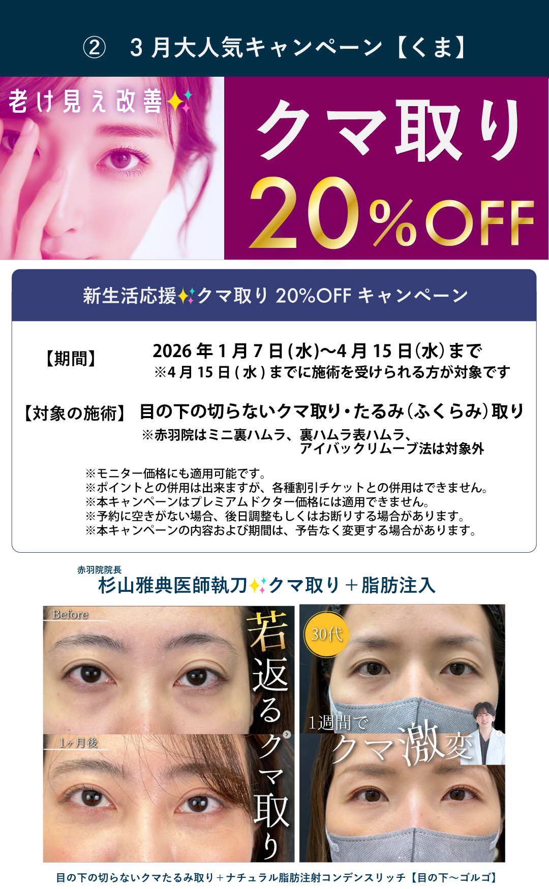 こちらも終了間近！【4月15日までに施術】目の下のくまとりキャンペーン🉐