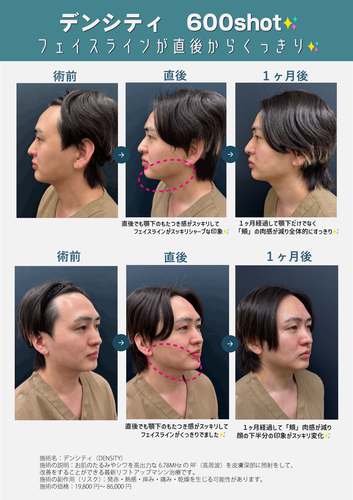 【必見】赤羽院院長の《施術前→直後→１ヶ月後》の変化