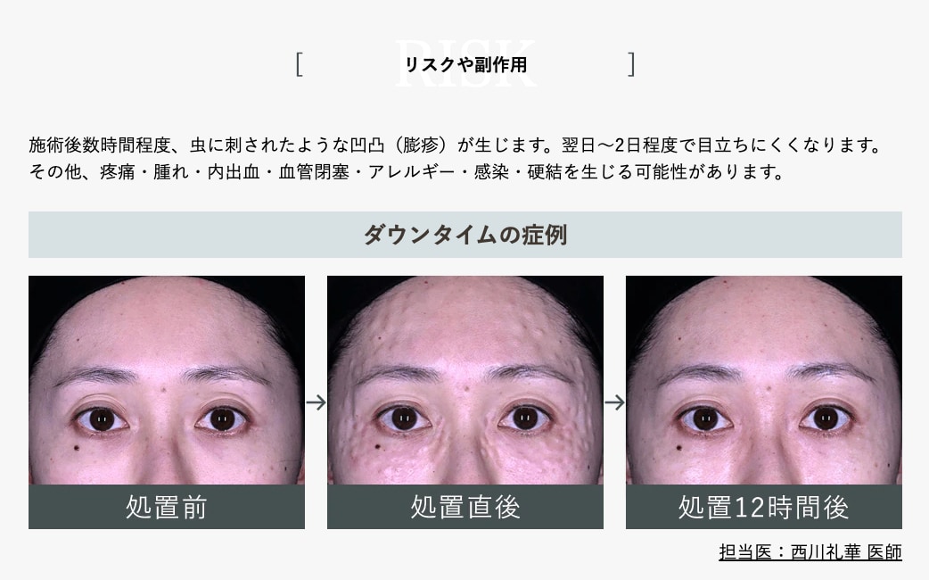 注入直後のぶつぶつや腫れの経過
